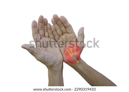 Elder hands with untreated carpel tunnel syndrome (CTS), case showing shrinkage (atrophy) of the muscles at the base of the thumb. Clipping path.