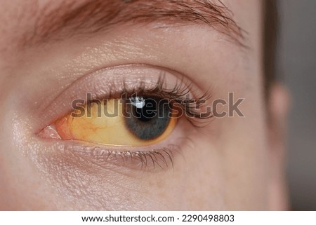 Woman with yellow eyes on blurred background, closeup. Symptom of hepatitis Royalty-Free Stock Photo #2290498803