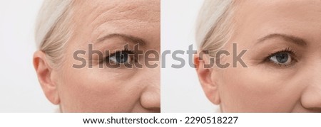 Woman looking better due to cosmetic procedures. Collage with photos on white background before and after rejuvenation, closeup