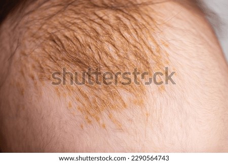 The process of formation of seborrheic dermatitis in an infant on the head. Scaly crusts, close-up Royalty-Free Stock Photo #2290564743