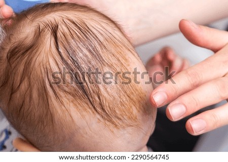 Smearing a seborrheic crust with baby oil on a child's head. Combing and removal of seborrheic crust, close-up Royalty-Free Stock Photo #2290564745