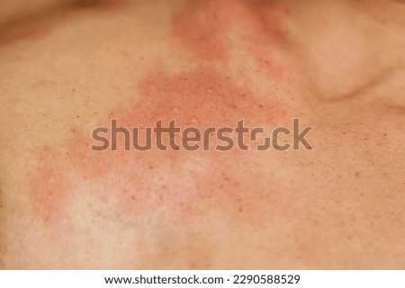 Consequences of removing papillomas on the girl's body with an electrocoagulator, burning them with high-frequency current. Royalty-Free Stock Photo #2290588529