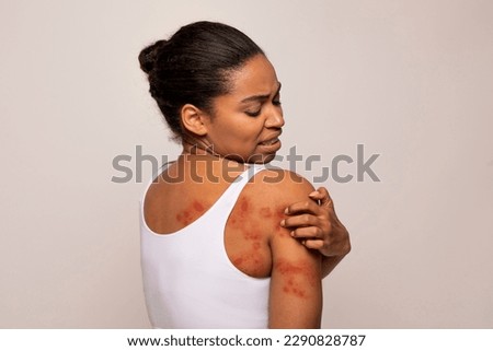 Sensitive Skin, Food allergy symptoms, Irritation. Annoyed young african american woman scratching red spots all over her body, isolated on grey studio background, copy space, back view Royalty-Free Stock Photo #2290828787