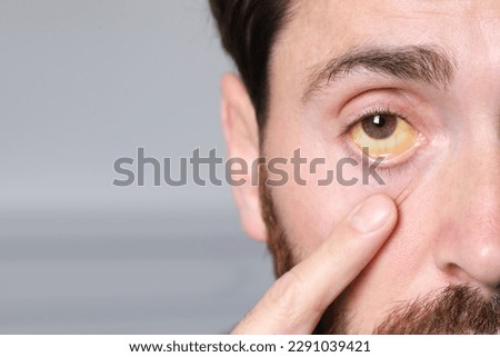 Man with yellow eyes on blurred background, closeup. Symptom of hepatitis Royalty-Free Stock Photo #2291039421