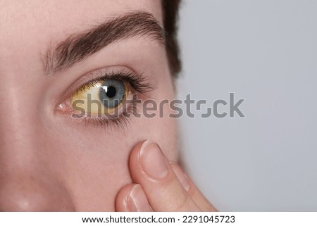 Woman with yellow eyes on white background, closeup. Symptom of hepatitis Royalty-Free Stock Photo #2291045723