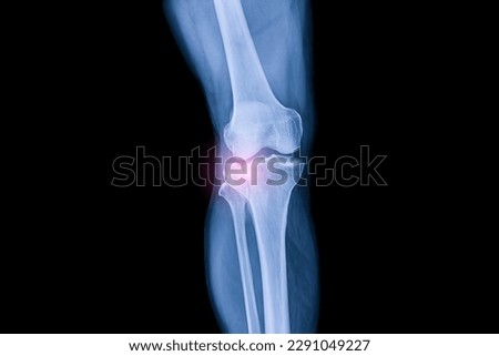 Knee x ray after car accident in orthopedic unit inside trauma hospital.X-ray shows tibia plateau bone fracture.Patient needs surgery.Xray technology in blue on black background.Red light effect. Royalty-Free Stock Photo #2291049227