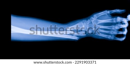 Forearm x ray after car accident in orthopedic unit inside trauma hospital.X-ray shows radius and ulna bone fracture.Patient needs surgery.Xray technology in blue on black background. Royalty-Free Stock Photo #2291903371