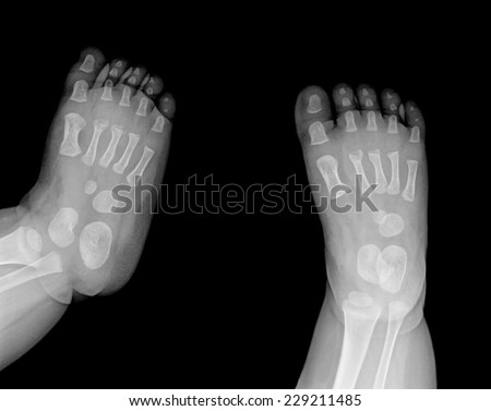 x-ray photo of baby feets