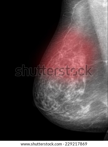 Mammogram films of breasts of a female patient