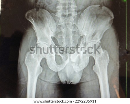 Film x-ray Pelvis AP view Showing fracture ilium left side.Medical image concept.Soft and blurry image. Royalty-Free Stock Photo #2292235911