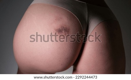 Bruise on a woman's buttock. Hematoma after injection. Buttock injury. Isolated on a gray background. Close-up.