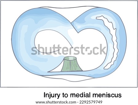 Injury to medial meniscus vector design