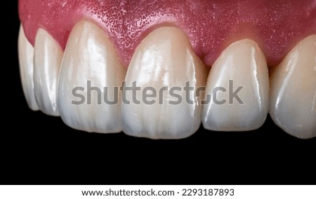 Emax ceramic crowns and veneers like natural teeth Royalty-Free Stock Photo #2293187893