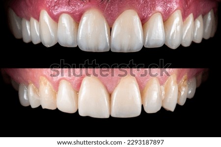Emax ceramic crowns and veneers like natural teeth Royalty-Free Stock Photo #2293187897