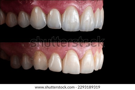 Emax ceramic crowns and veneers like natural teeth Royalty-Free Stock Photo #2293189319