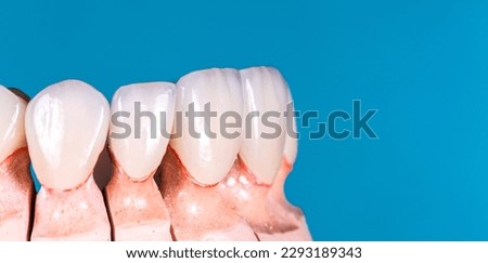 Emax ceramic crowns and veneers like natural teeth Royalty-Free Stock Photo #2293189343