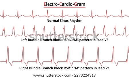 Set of ECG Common Abnormalities - Left Bundle Branch Block vs Right Bundle Branch Block - Normal Sinus Rhythm - Medical Vector Illustration Royalty-Free Stock Photo #2293224319