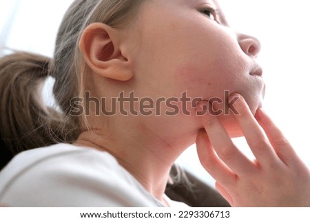 The child scratches atopic skin. Dermatitis, diathesis, allergy on the child's face. Royalty-Free Stock Photo #2293306713