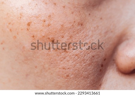 Woman's problematic skin pore and dark spots on the face Royalty-Free Stock Photo #2293413661