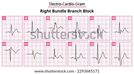 Right Bundle Branch Block - The Differences in ECG Waveform for Each of the 12 Leads - Medical Vector and Illustration Royalty-Free Stock Photo #2293685171