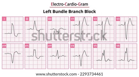 Left Bundle Branch Block - The Differences in ECG Waveform for Each of the 12 Leads - Medical Vector and Illustration Royalty-Free Stock Photo #2293734461