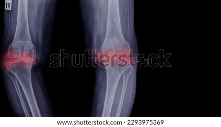 X-ray picture of the knee of an elderly woman. Both knees have osteoarthritis. Very painful. Blue tone. Black background.