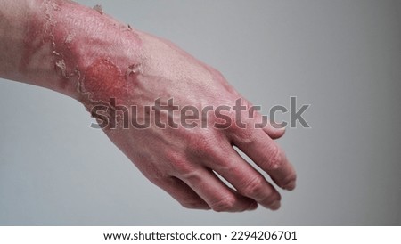 Close-up of a woman's hand with a burst blister from a boiled water burn, broken skin, 1st or 2nd degree burn. Painful wound. Thermal burn. Skin peels off after a burn, wound treatment. macro photo. Royalty-Free Stock Photo #2294206701