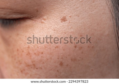 Freckles Over Asian Woman Face,Skin Problems Royalty-Free Stock Photo #2294397823
