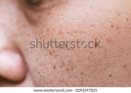 Freckles Over Asian Woman Face,Skin Problems Royalty-Free Stock Photo #2294397825