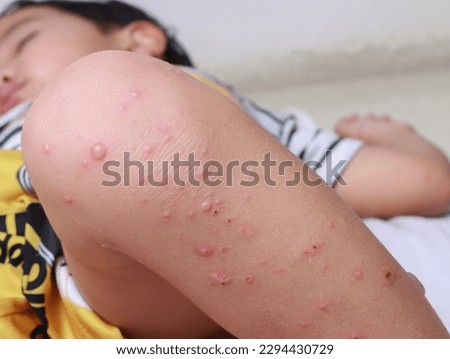 Hand foot and mouth virus causes red blisters on the knees leg plague with children in the rainy season Royalty-Free Stock Photo #2294430729