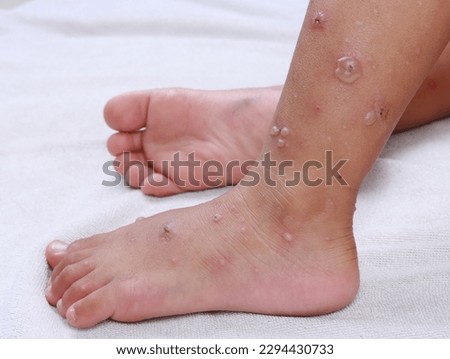 hfmd hand foot mouth virus red blisters on both legs and feet epidemic in sick children Painful red rash, epidemic medical treatment in rainy season White background Isolated Royalty-Free Stock Photo #2294430733