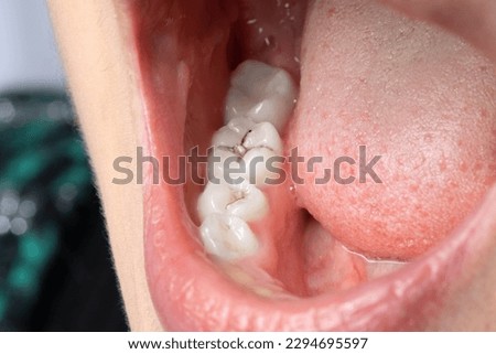 Close up of a woman's mouth with dental caries. Macro of teeth with black spots due to the action of caries bacteria. Oral hygiene and dental care concept. Royalty-Free Stock Photo #2294695597
