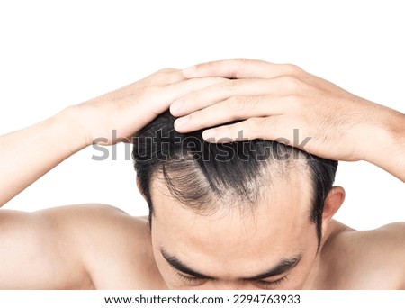 Closeup Young man serious hair loss problem with white backgroun for health care medical and shampoo product concept, selective focus Royalty-Free Stock Photo #2294763933