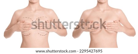 Breast augmentation with silicone implants. Collage with photos of woman before and after plastic surgery on white background, closeup