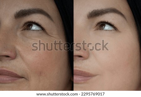Woman face wrinkle before and after treatment Royalty-Free Stock Photo #2295769017
