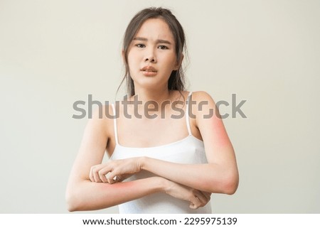 Dermatology asian young woman, girl allergy, allergic reaction from atopic, insect bites on her arm, hand in scratching itchy, itch red spot or rash of skin. Healthcare, treatment of beauty. Royalty-Free Stock Photo #2295975139