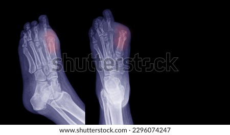 X-ray image of a diabetic foot ulcer showing atrophy of the joint and amputation of the toe, blue tones, black background.