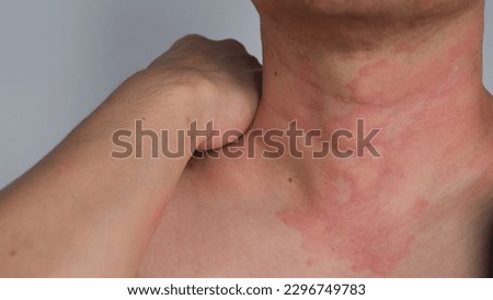Close up image of skin texture suffering severe urticaria or hives or kaligata on neck. Allergy symptoms. Royalty-Free Stock Photo #2296749783
