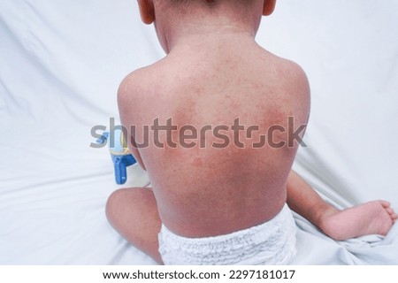 Close up image of baby skin texture suffering prickly heat on back. Allergy of Miliaria Rubra. Royalty-Free Stock Photo #2297181017
