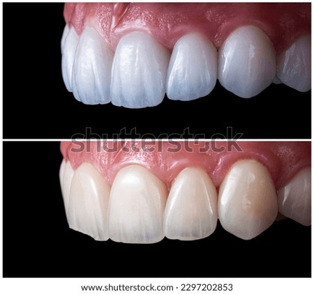 before and after picture of ceramic restorations on teeth by emax and zirkon crowns and veneers