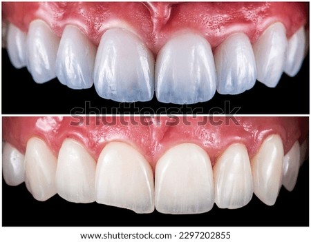 before and after picture of ceramic restorations on teeth by emax and zirkon crowns and veneers Royalty-Free Stock Photo #2297202855