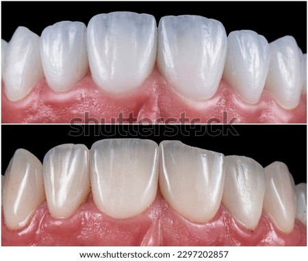 before and after picture of ceramic restorations on teeth by emax and zirkon crowns and veneers