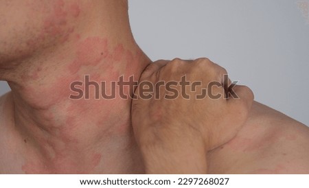 Close up image of skin texture suffering severe urticaria or hives or kaligata on neck. Allergy symptoms. Royalty-Free Stock Photo #2297268027