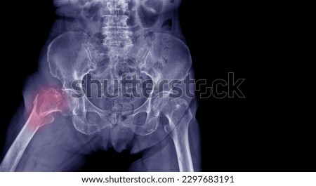 X-ray the patient's hip to diagnose lesions and abnormalities. A hip fracture was found. Express pain, blue tone, black background Royalty-Free Stock Photo #2297683191