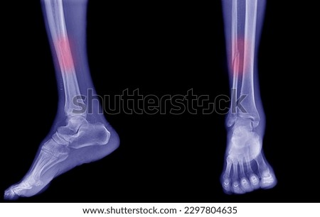 x-ray leg accident patient Central fractures were found. Show pain, blue tone, black background