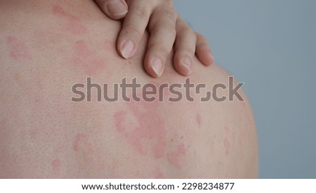 Close up image of skin texture suffering severe urticaria or hives or kaligata on back. Allergy symptoms. Royalty-Free Stock Photo #2298234877