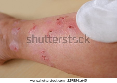 doctor treats weeping wounds, venous ulcers on female leg, diabetes mellitus, varicose veins prevents healing ulcers, eliminating inflammatory process, sanitation pathogenic microflora Royalty-Free Stock Photo #2298541645