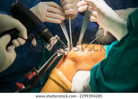Team of doctor or surgeon in blue gown inside operating room in hospital.Surgeon did total knee joint replacement surgery technology.Osteotomy with medical saw at orthopedic unit.Light background. Royalty-Free Stock Photo #2299394285