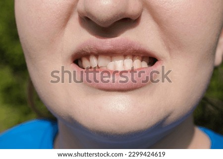 Patient woman with dislocated jaw and malocclusion, temporomandibular joint dysfunction. She is opening her mouth and shows this disfunction Royalty-Free Stock Photo #2299424619