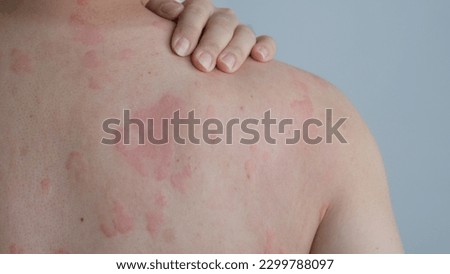 Close up image of skin texture suffering severe urticaria or hives or kaligata on back. Allergy symptoms. Royalty-Free Stock Photo #2299788097